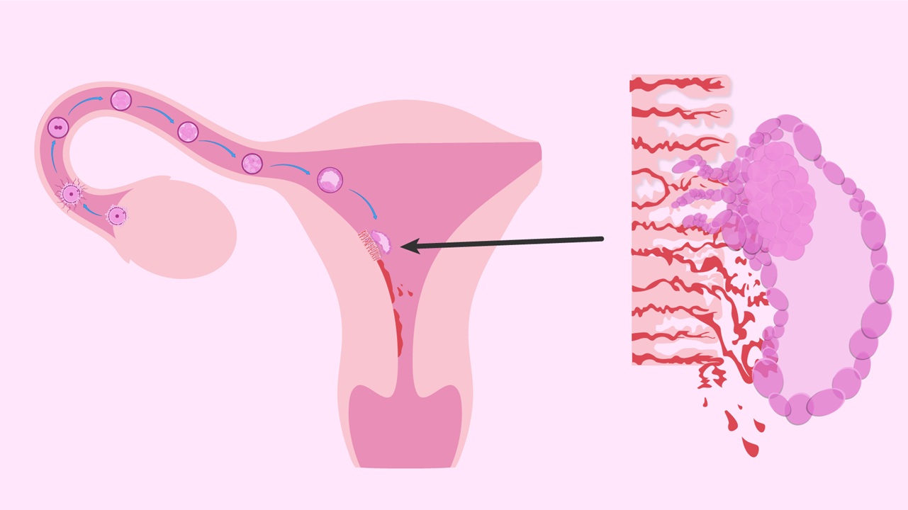 egg implantation calculator
